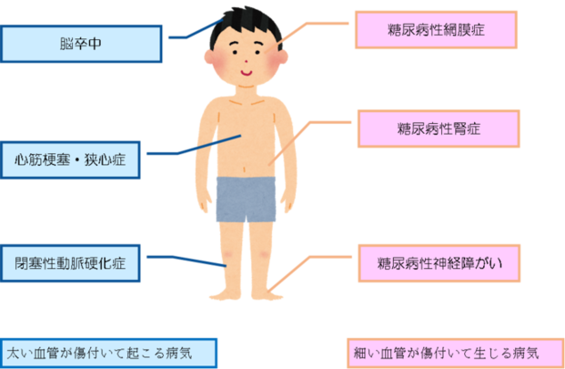 糖尿病合併症イラスト：太い血管が傷付いて起こる病気（脳卒中、心筋梗塞・狭心症、閉塞性動脈硬化症）、細い血管が傷付いて生じる病気（糖尿病性網膜症、糖尿病性腎症、糖尿病性神経障がい）