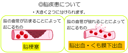 図：脳疾患について　脳疾患は、脳の血管が詰まることによって起こる脳梗塞と、脳の血管がや破れることによって起こる脳出血・くも膜下出血があります。