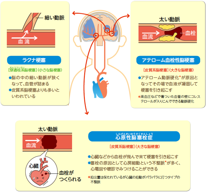 脳梗塞